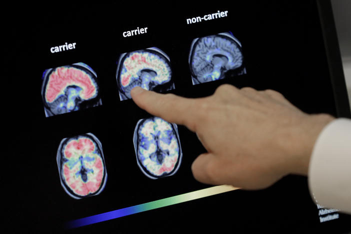 Dr. William Burke goes over a PET brain scan in 2018 at Banner Alzheimer's Institute in Phoenix. The drug company Biogen has received federal approval for a medicine to treat early Alzheimer's disease.