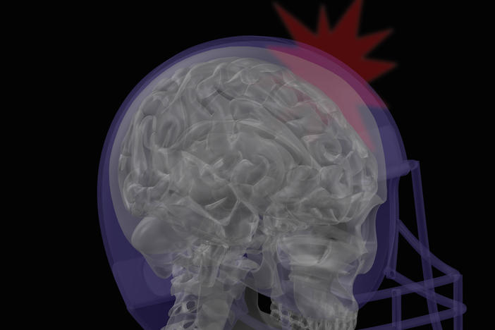 Researchers are studying athletes and military personnel to learn more about how a concussion can affect the brain's ability to understand sound.