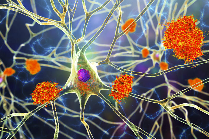 Amyloid plaques are characteristic features of Alzheimer's disease. The new drug Aduhelm is able to remove this sticky substance that builds up in the brains of patients with the disease, but many doctors are still skeptical of how well it really works.