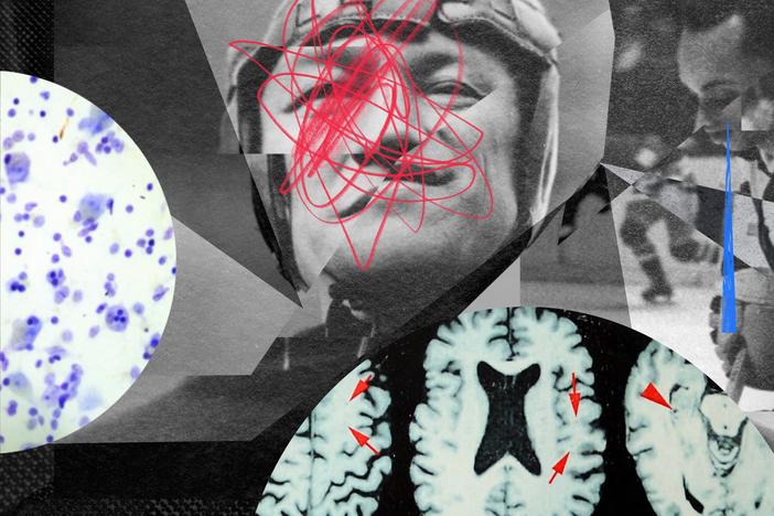 The degenerative brain condition CTE can be diagnosed only through autopsy. But there's a quiet population of everyday people afraid they have it — and they're turning to dubious treatments.