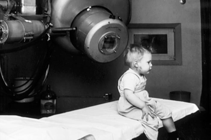 Gordon Isaacs, the first patient treated with the linear accelerator (radiation therapy) for retinoblastoma in 1957, sitting on a table. Gordon's right eye was removed January 11, 1957 because the cancer had spread. His left eye, however, had only a localized tumor that prompted Henry Kaplan to try to treat it with the electron beam. Gordon's vision in the left eye returned to normal.