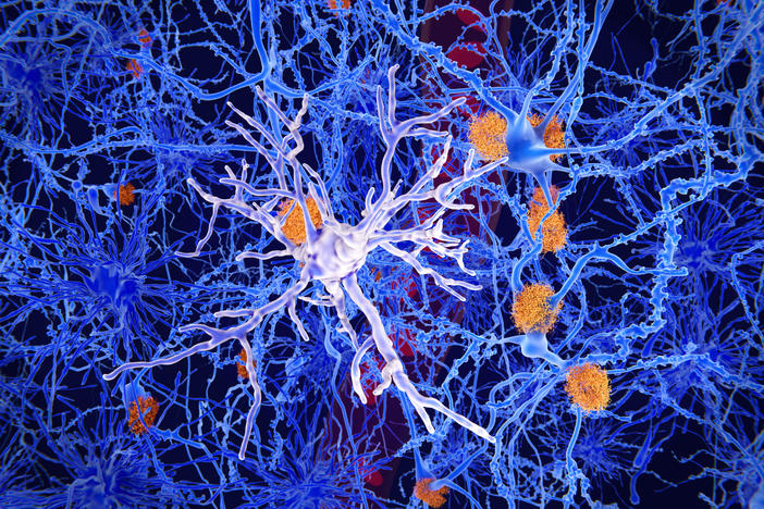 Microglia, specialized cells like the one seen in the center of this image, can restrain the accumulation of beta-amyloid protein (plaques in orange) that are a hallmark of Alzheimer's disease. But the cells sometimes contribute to the progression of the illness, researchers say.