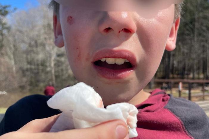 The Peachtree City Police Department in Georgia shared an image of a young boy bloodied by an alleged assault by teens participating in the Orbeez Challenge.