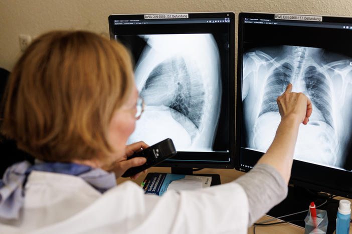 Refugees from Ukraine, which has a high rate of tuberculosis, are often screened for the disease. Above: Dr. Natalie Wöhrle analyzes the X-ray images of the lungs from a screening in Gauting, Germany, on March 12.