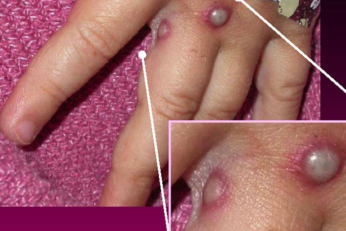 Symptoms of the monkeypox virus are shown on a patient's hand, from a 2003 case in the United States. In most instances, the disease causes fever and painful, pus-filled blisters. New cases in the United Kingdom, Spain and Portugal are spreading possibly through sexual contact, which had not previously been linked to monkeypox transmission.