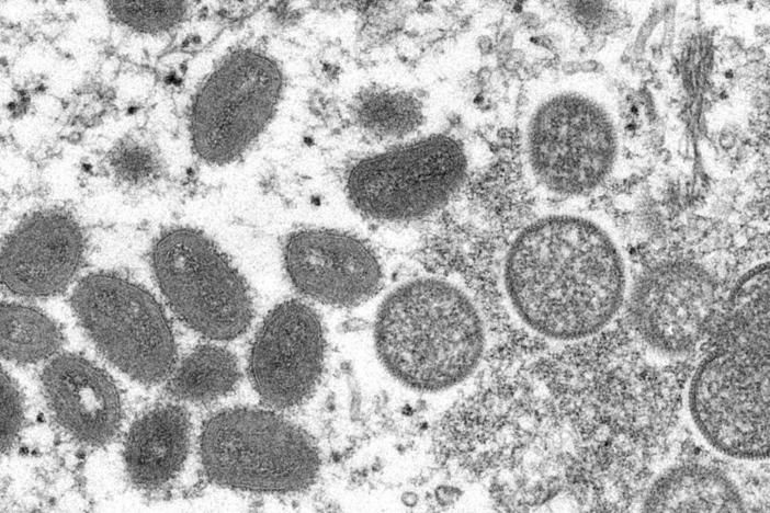 This 2003 electron microscope image made available by the Centers for Disease Control and Prevention shows mature, oval-shaped monkeypox virus particles, left, and spherical immature particles, right.
