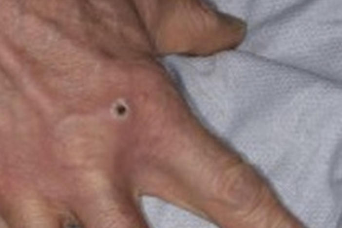 Above: a monkeypox lesion. The lesions in cases that are part of the 2022 outbreak are often first seen on genitalia or the anus. Spread to other parts of the body is possible but doesn't always occur.