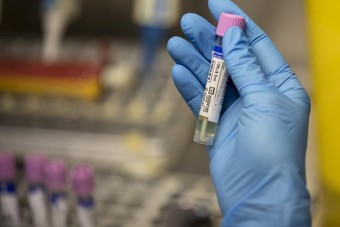 A medical technician shows a suspected monkeypox sample at the microbiology laboratory of La Paz Hospital on June 6 in Madrid. The World Health Organization is working with experts on changing the name of the virus.