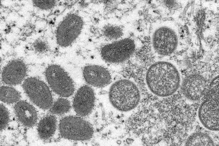 This 2003 electron microscope image made available by the Centers for Disease Control and Prevention shows mature, oval-shaped monkeypox virions, left, and spherical immature virions, right, obtained from a sample of human skin associated with the 2003 prairie dog outbreak.