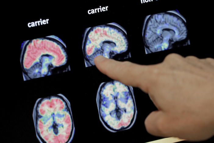 Scientists say research into Alzheimer's needs to take a broader view of how the disease affects the brain — whether that's changes in the cortex or the role of inflammation.