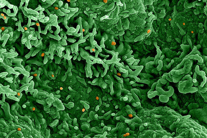 An image from an electron microscope of the monkeypox virus (orange) on infected cells (green).