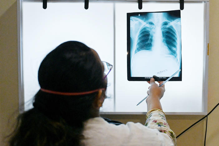 A doctor checks chest x-rays of a tuberculosis patient at a clinic in Mumbai, India, that treats those with drug-resistant strains of the disease. Two new studies look at how drug resistance might be overcome.