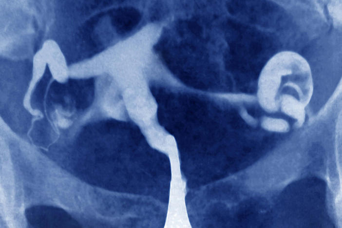 A color-enhanced scan of an ectopic pregnancy, which develops outside the uterus — often inside a fallopian tube. Such pregnancies are never viable and, unless ended, can lead to rupture of the tube, severe bleeding and even death.