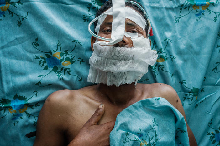 An injured Tigray People's Liberation Front fighter who was shot in the cheek recovers after surgery at the Ayder Comprehensive Specialized Hospital in Mekele, the capital of Ethiopia's Tigray region. It's the only place in Tigray currently conducting surgery. Elsewhere, "they are stopped because there is no supply, there is no electricity, and there is no fuel," says one Tigray doctor.