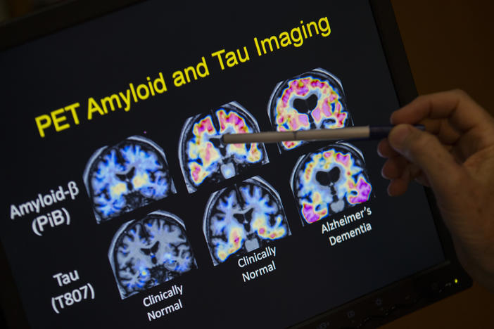 A doctor points to PET scan results that are part of Alzheimer's disease research. Much work in the field focuses a substance called beta-amyloid. A new study could test whether that's the right target.