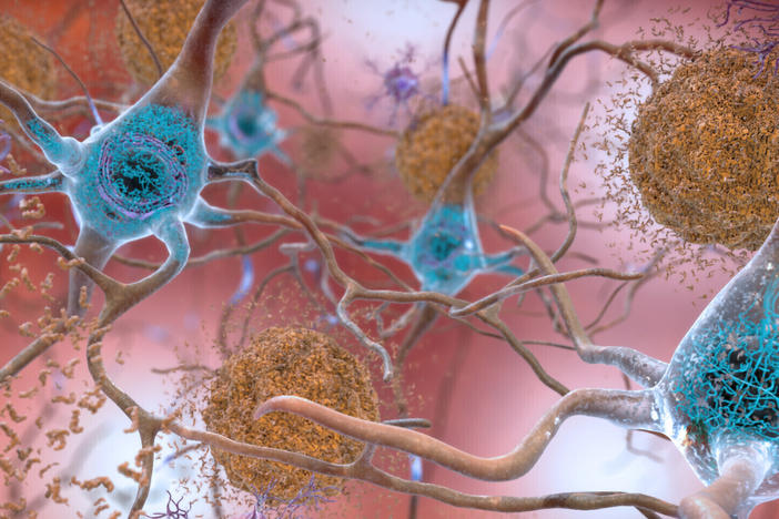 This illustration made available by the National Institute on Aging/National Institutes of Health depicts cells in an Alzheimer's-affected brain. An experimental drug modestly slowed the brain disease's progression, researchers reported Tuesday.