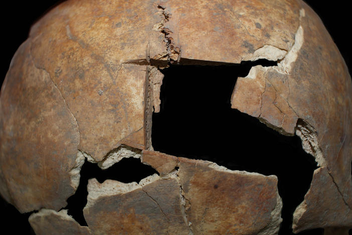This hole was made in a Bronze Age man's skull shortly before he died, archaeologists say, based on several clues. It's the result of a surgical procedure called a trephination.