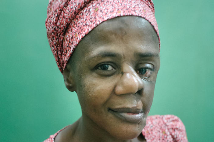 Mulikat Okanlawon of Nigeria contracted noma when she was a child. The gangrenous infection ate away at the flesh and bone in her face. She survived and has had surgery to repair scars left by the disease. Today she works at the Sokoto Noma Hospital, guiding noma patients on the road to recovery.
