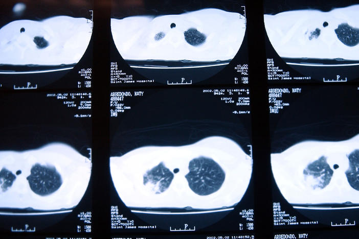 X-rays of a patient with tuberculosis, taken in November 2002 in New Jersey, show damage to the lungs.