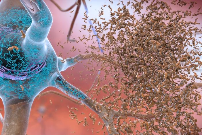 In patients with Alzheimer's disease, a substance called beta-amyloid can form toxic clumps in between neurons. Drugs like lecanemab are designed to remove amyloid-beta from the brain.