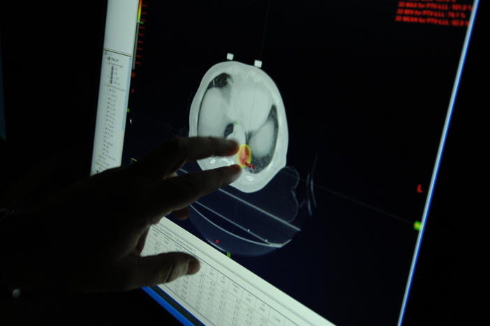 A doctor assesses a radio surgery treatment plan for a patient with lung cancer, using a 4D CAT scan. Lung cancer survival rates have increased lately.