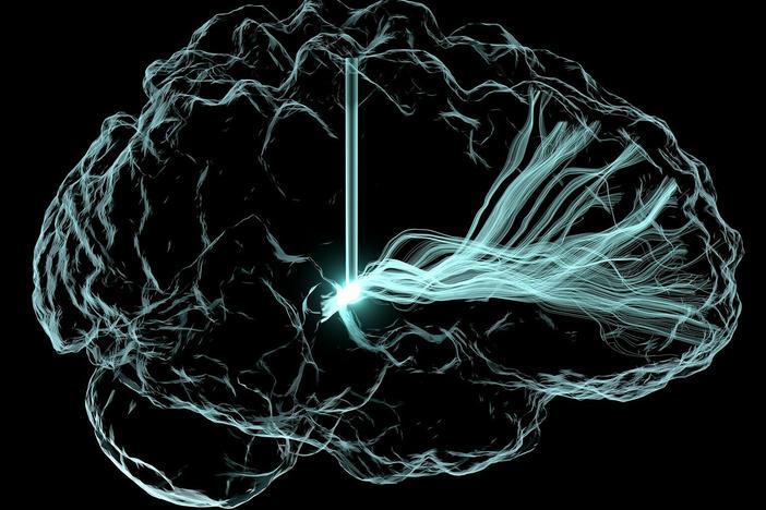 An artistic rendering of deep brain stimulation. Scientists are studying this approach to see if it can treat cognitive impairment that can arise after a traumatic brain injury and other conditions.