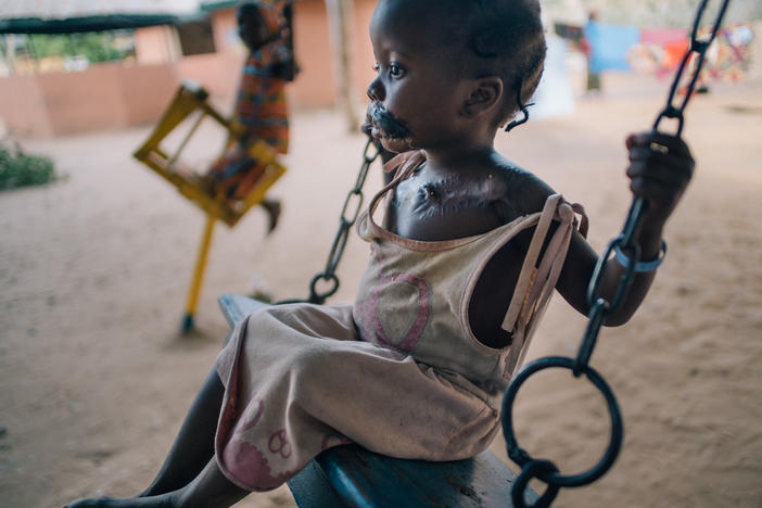 A young girl in the courtyard of Nigeria's Sokoto Noma Hospital. She arrived with her mother for reconstructive operations, including a skin graft taken from her chest to replace tissue destroyed by noma.