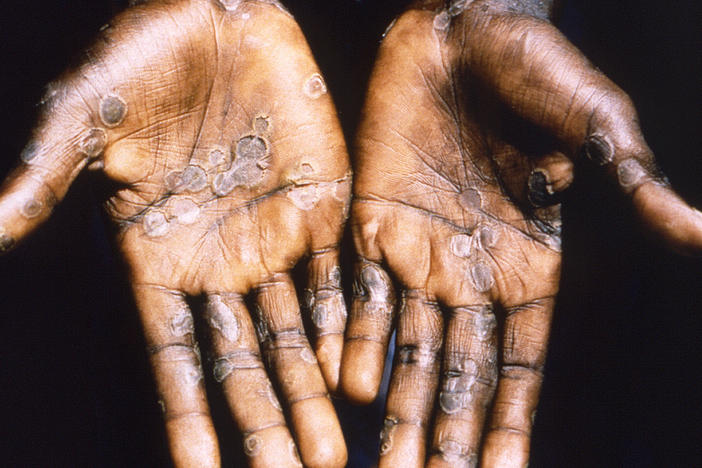The palms of a patient with mpox during a past outbreak in the Democratic Republic of Congo in 1997. The country is now seeing a dramatic spike in mpox.