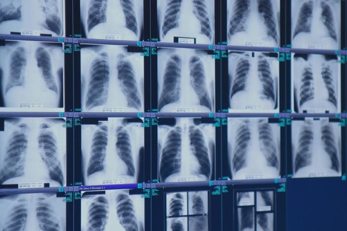 The safety rules being announced and finalized today will hold mines to the same standard for silica dust exposure as other employers. These x-rays show black lung disease.