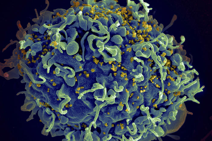 This electron microscope image made available by the U.S. National Institutes of Health shows a human T cell, in blue, under attack by HIV, in yellow, the virus that causes AIDS.