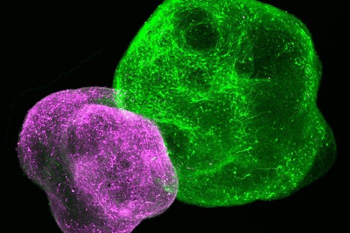 This image shows a brain "assembloid" consisting of two connected brain "organoids." Scientists studying these structures have restored impaired brain cells in Timothy syndrome patients.