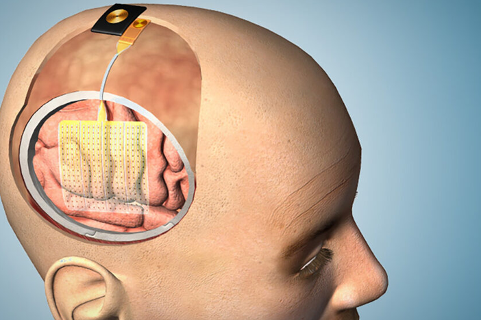 This illustration shows how the thin film of sensors could be applied to the brain before surgery. 