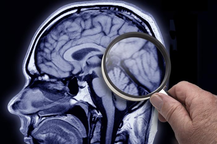 A key protein called Reelin may help stave off Alzheimer's disease, according to a growing body of research. 