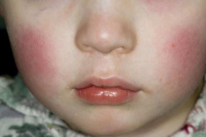 A parvovirus B19 infection can cause a facial rash in children, which is why the disease caused by the virus is sometimes called "slapped-cheek disease."