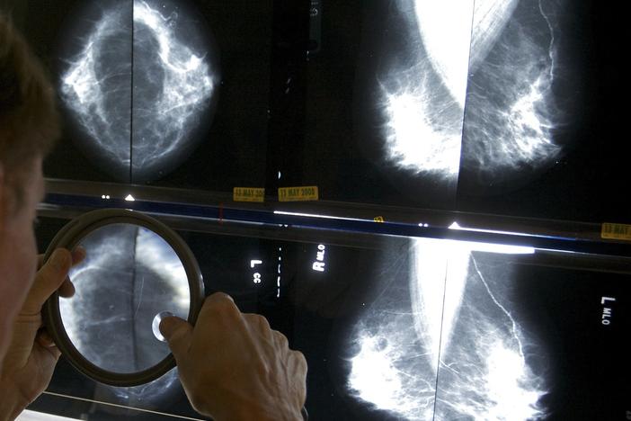 A radiologist uses a magnifying glass to check mammograms for breast cancer.  Breast density is a risk factor for cancer.