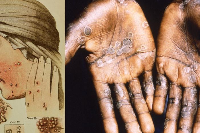 Smallpox and mpox are related diseases — and the eradication of the former inadvertently creating an opening for the latter. At left: An illustration from 1884 depicts smallpox pustules on the face and hand of a woman. At right: A 1997 photograph shows the palms of a woman who contracted mpox during an outbreak in the Democratic Republic of Congo.<br>