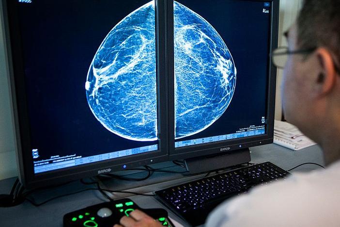 When radiologists review mammograms for signs of breast cancer, they can also see arterial calcification in the breast, which is linked with cardiovascular disease risk.