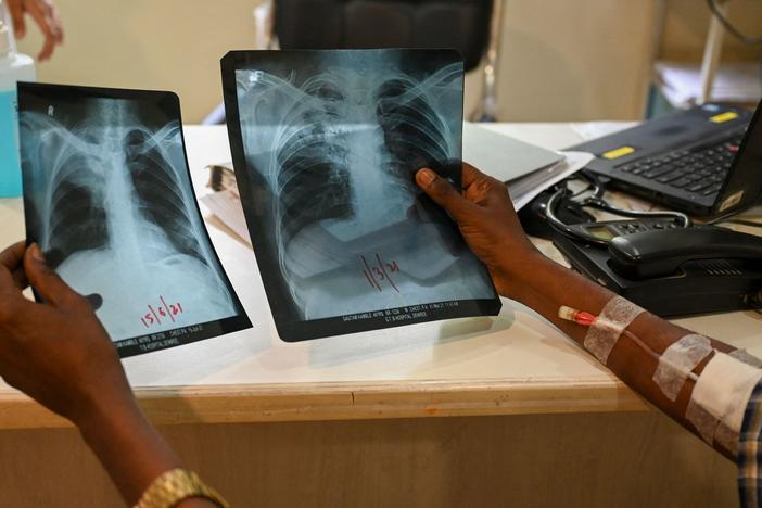 A patient who was diagnosed with tuberculosis holds his chest x-rays while consulting with a doctor at the Médecins Sans Frontières clinic in Mumbai, which treats people with drug-resistant tuberculosis.