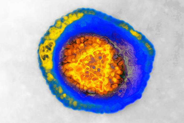An image of the human herpes virus, HSV, taken with transmission electron microscope. Two types can cause genital herpes: HSV-1 and HSV-2.