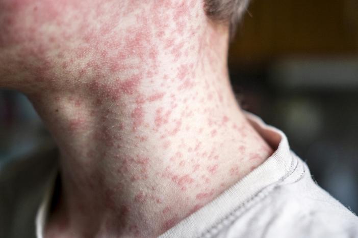Measles spreads easily. It's one of the world's most contagious diseases.