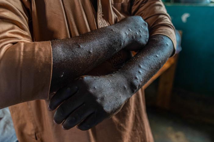 Lesions can be seen on this mpox patient in the Democratic Republic of Congo, the epicenter of an outbreak in Africa.