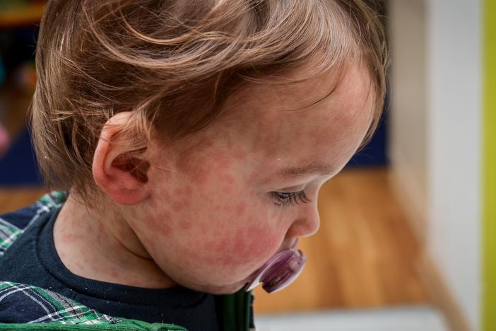 Most kids recover from measles. But the virus can be deadly and can erase the immune system's memory.
