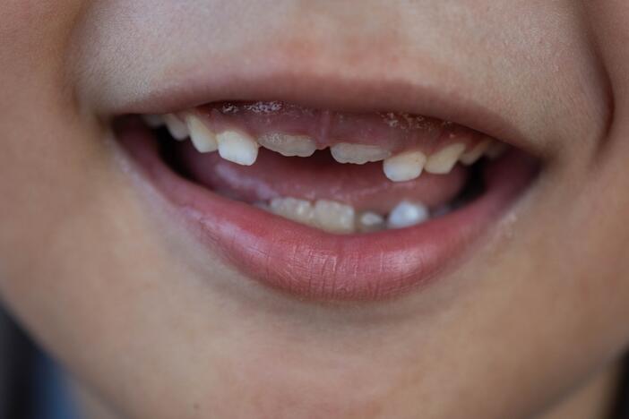 Dentists sometimes prescribe fluoride supplements to kids in areas that lack water fluoridation. FDA is taking action to remove such treatments from the market.