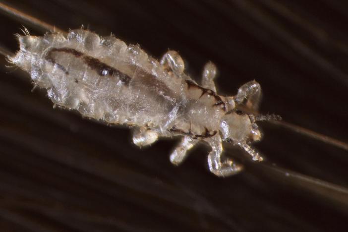 How Lice Turn Your Hair Into Their Jungle Gym: asset-mezzanine-16x9
