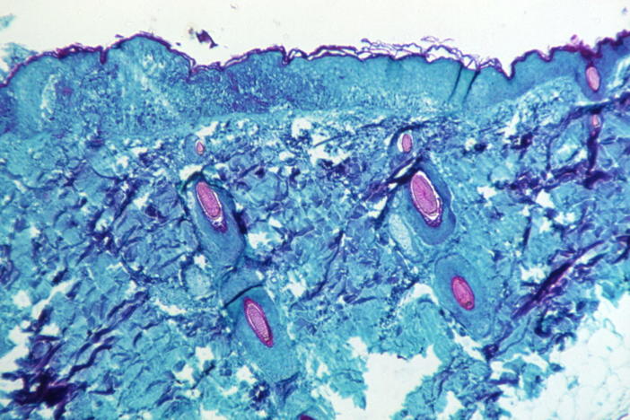 A section of skin tissue, harvested from a lesion on the skin of a monkey, that had been infected with monkeypox virus, is seen at 50X magnification on day four of rash development in 1968. CDC handout via Reuters.